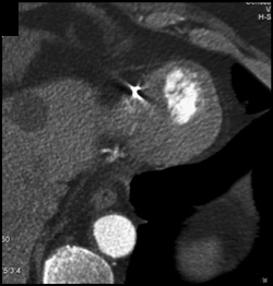 Left Ventricle With Hypertrophy and Aneurysm - CTisus CT Scan