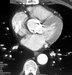 Aortic Valve - CTisus CT Scan