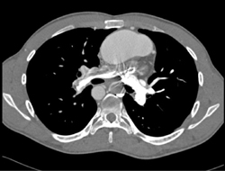 Chronic Pulmonary Embolism - CTisus CT Scan