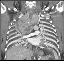 Substernal Thyroid - CTisus CT Scan