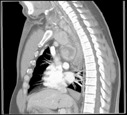 Substernal Thyroid - CTisus CT Scan