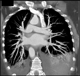 Nice Pulmonary Veins - CTisus CT Scan