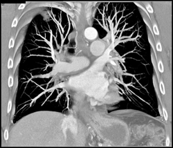 Nice Pulmonary Vasculature - CTisus CT Scan