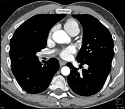 Chronic Pe - CTisus CT Scan