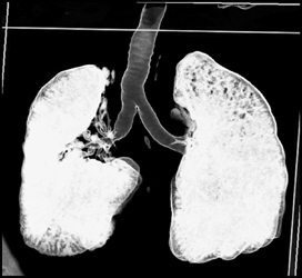 Bronchiectasis in Right Lung - CTisus CT Scan