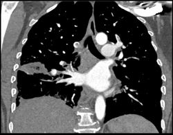 Pe - CTisus CT Scan