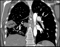 Pe - CTisus CT Scan