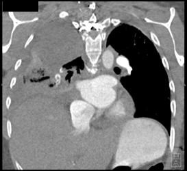 Pe - CTisus CT Scan