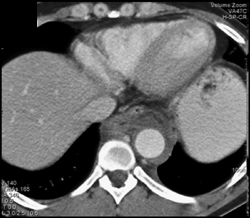 Hemorrhage Around Descending Aorta (see Next Image) - CTisus CT Scan