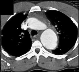 Aortic Dissection With Mediastinal Blood - CTisus CT Scan