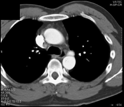 Traumatic Pseudoaneurysm - CTisus CT Scan