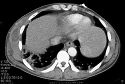 Chest Wall Abscess - Intravenous Drug Abuse (IVDA) - CTisus CT Scan