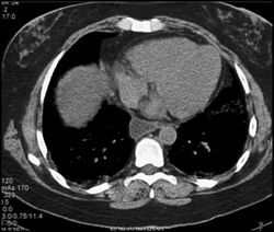 Scleroderma - CTisus CT Scan