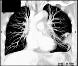 Pulmonary Infarct - CTisus CT Scan