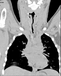 Tracheal Stenosis - CTisus CT Scan