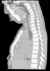 Tracheal Stenosis (traumatic Intubation) - CTisus CT Scan