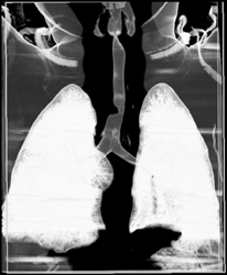 Vessel Compresses Trachea - CTisus CT Scan