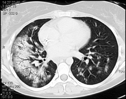 Pulmonary Hemorrhage - CTisus CT Scan