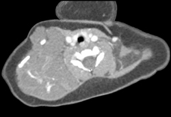 Hemangioma/lymphangioma - CTisus CT Scan