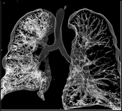 Right Lung Transplant With Patent Right Mainstem Bronchus - CTisus CT Scan