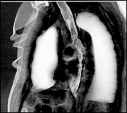 Stent in Distal Trachea- See Case 1467 - CTisus CT Scan