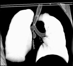 Stent in Distal Trachea- See Next Case - CTisus CT Scan