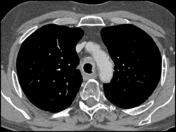 Carcinoma Involves Trachea With Narrowing Bifurcation - CTisus CT Scan