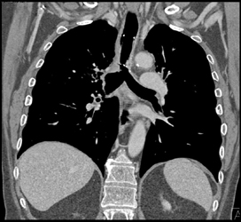 Stent in Distal Trachea - CTisus CT Scan