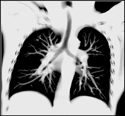 Patent Airway - CTisus CT Scan