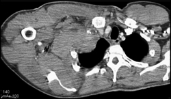 Hematoma Extrapleural Right Chest - CTisus CT Scan