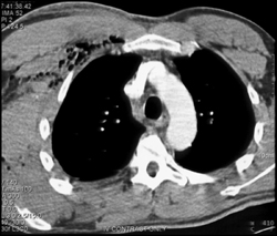 Hematoma in Axilla- Post Procedure - CTisus CT Scan