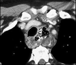 Mediastinal Abscess Due to Esophageal Perforation - CTisus CT Scan