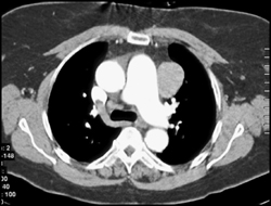 Thymoma - CTisus CT Scan