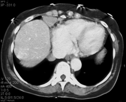 Paracardiac Nodes - CTisus CT Scan