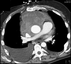 Hemopericardium - CTisus CT Scan