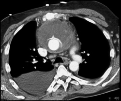 Hemopericardium Plus Mnediastinal Hematoma - CTisus CT Scan