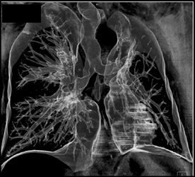 Tumor Invades Proximal Right Mainstem Bronchus (lung Cancer Primary) - CTisus CT Scan