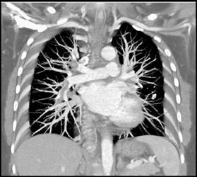 Pe - CTisus CT Scan