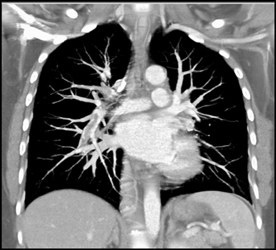 Pe - CTisus CT Scan