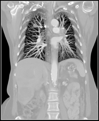 Pe - CTisus CT Scan