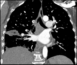 Pulmonary Embolism (PE) W/infarcts - CTisus CT Scan