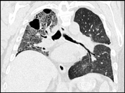 Narrowing Left Mainstem Bronchus - CTisus CT Scan