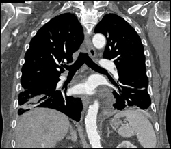 Subtle Left Pe - CTisus CT Scan