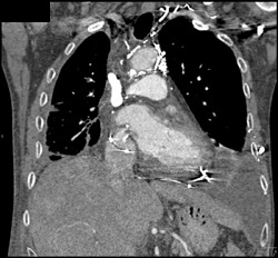 SVC Occlusion With Collaterals - CTisus CT Scan