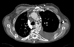 SVC Occlusion With Collaterals - CTisus CT Scan