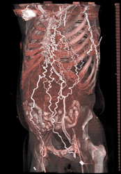 SVC Occlusion With Collaterals - CTisus CT Scan