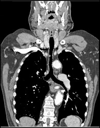 Polyp in Trachea - Chest Case Studies - CTisus CT Scanning
