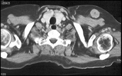 Metastatic Melanoma-subcutaneous Nodule - CTisus CT Scan