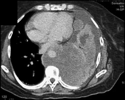 Aorta Encased By Tumor - CTisus CT Scan