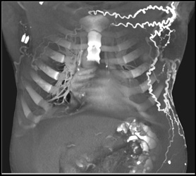 Collaterals in Axillary Due to SVC Occlusion - CTisus CT Scan